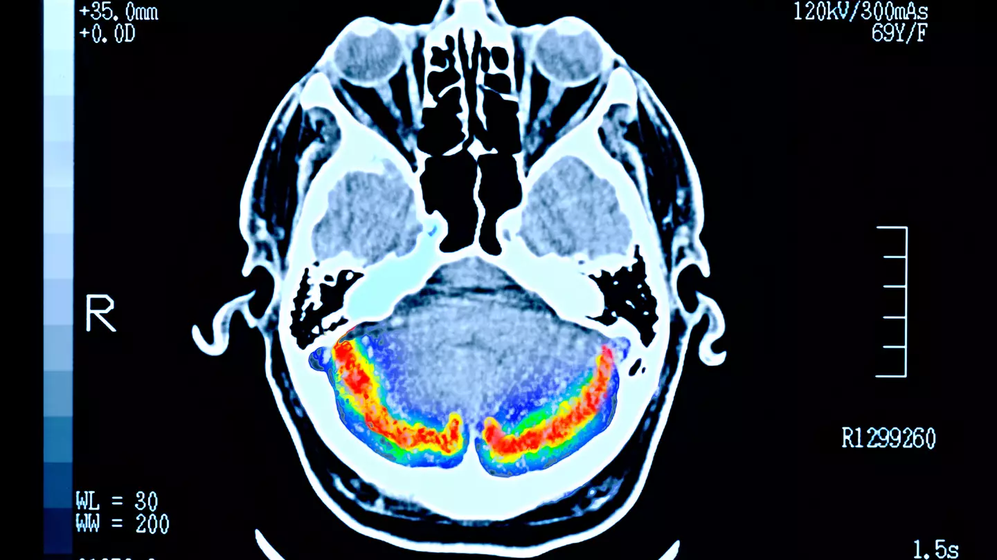Scientists discover Alzheimer's cause could actually come from inside your mouth