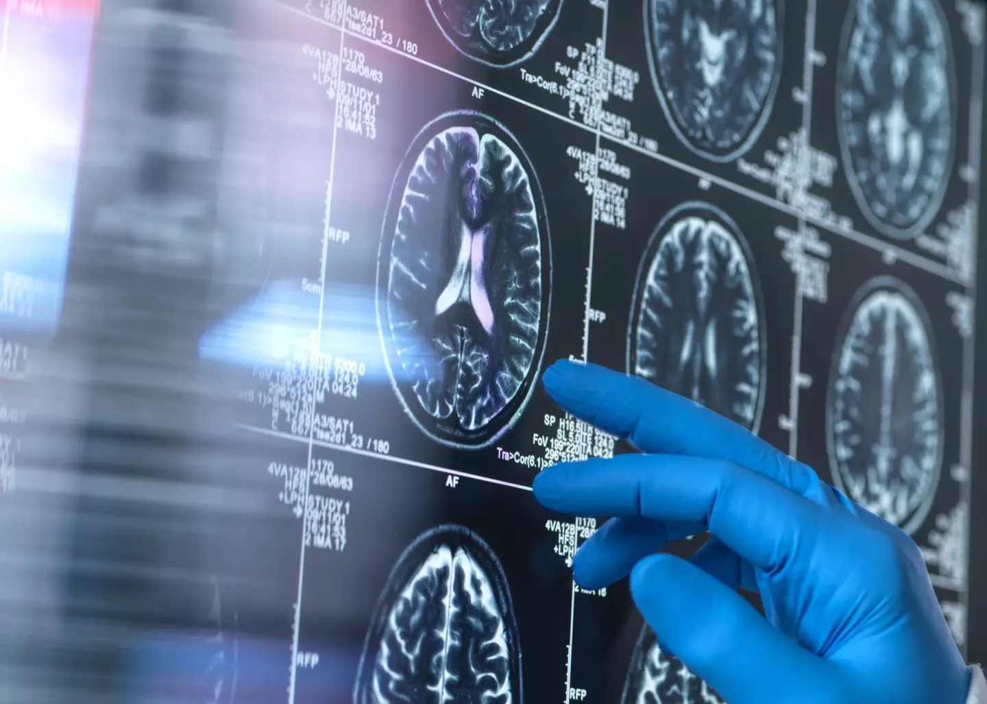 Dementia has been linked to this one thing (Getty stock images)