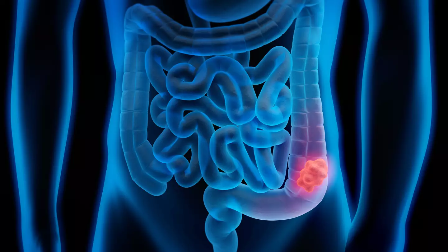 Colorectal surgeon reveals five foods that increase your risk of cancer