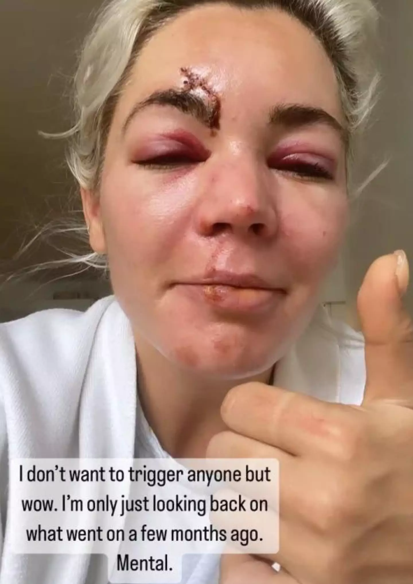 Danni was left with two black eyes and big gashes on her lip and eyebrow.