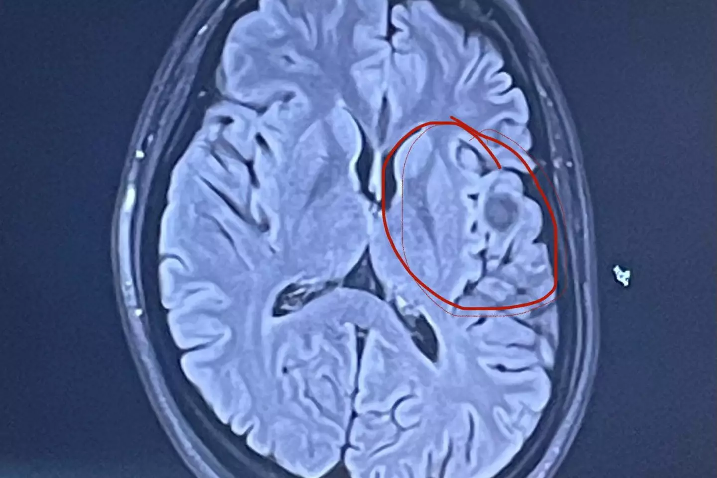 She was diagnosed with a non-cancerous cavernoma (SWNS)