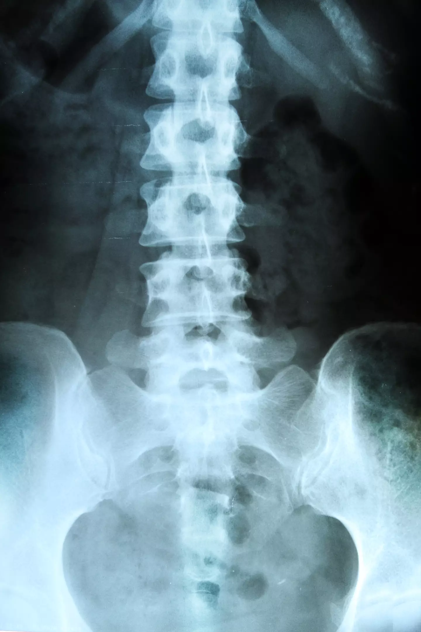 MS is two to three times more common in women than it is in men, according to studies (cozyta / Getty Images)