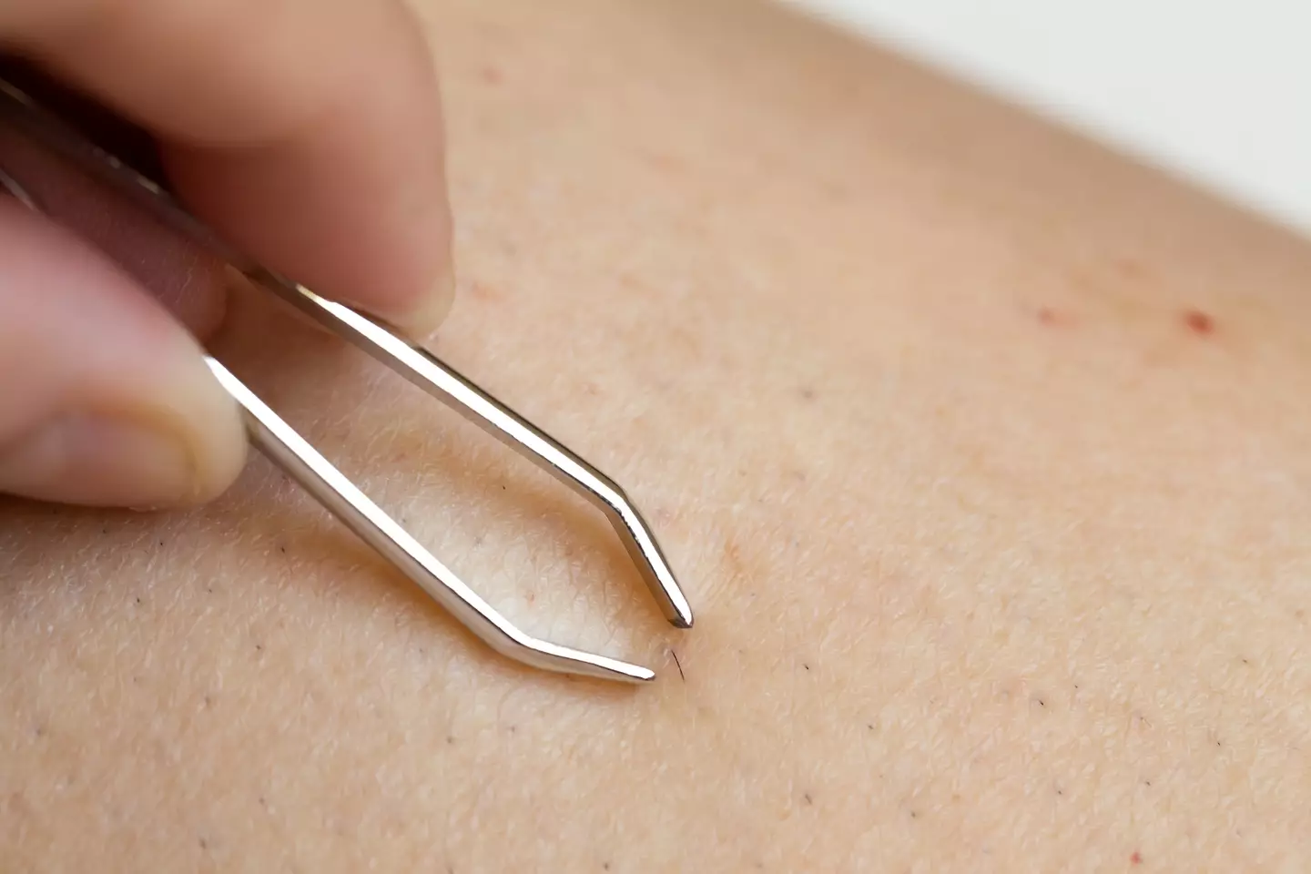 NHS are warning people how best to prevent an ingrown hair.