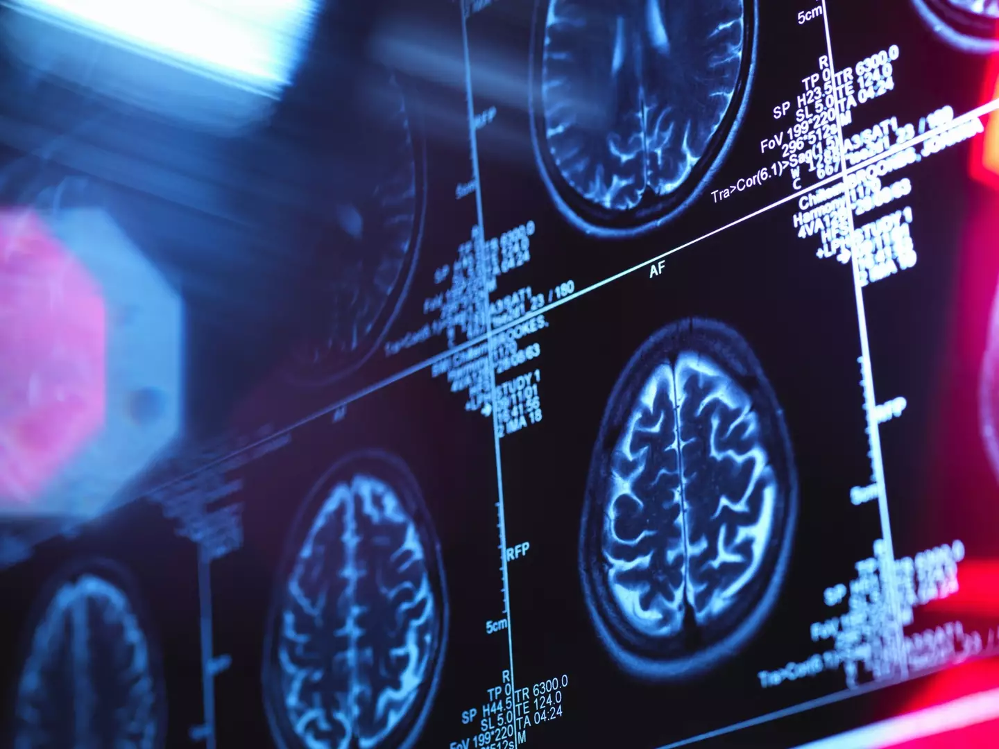 Dementia is a syndrome associated with an ongoing decline of brain functioning (Getty Stock Image)