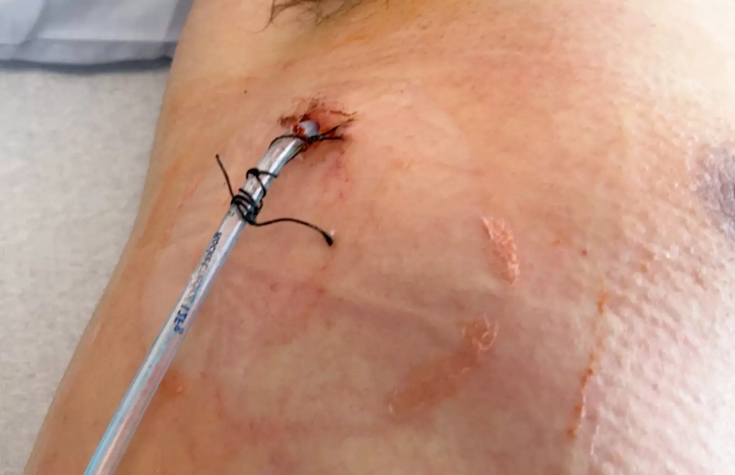 The New Zealand native had to have a tube inserted into his lung (SWNS)