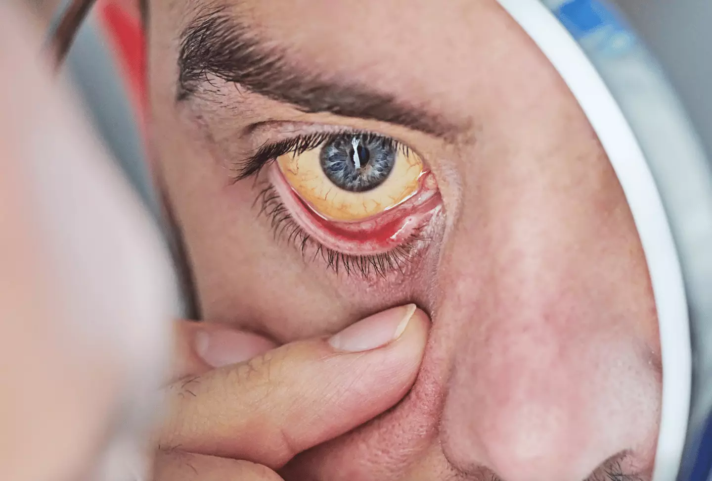 Side effects of daily aspirin consumption include the whites of your eyes turning yellow (Getty Stock Images)