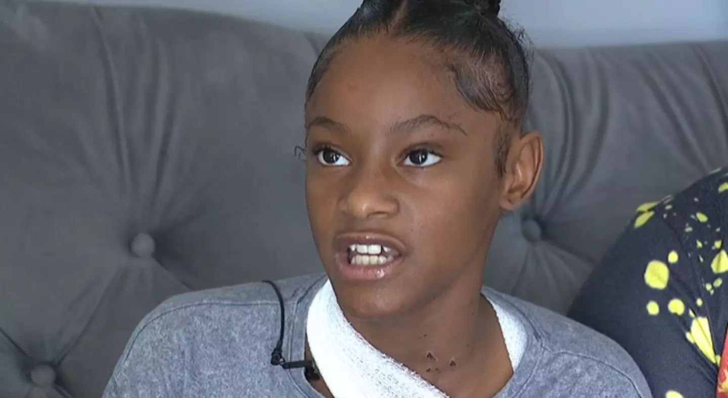 Deaira Summers was attacked with acid by another child.