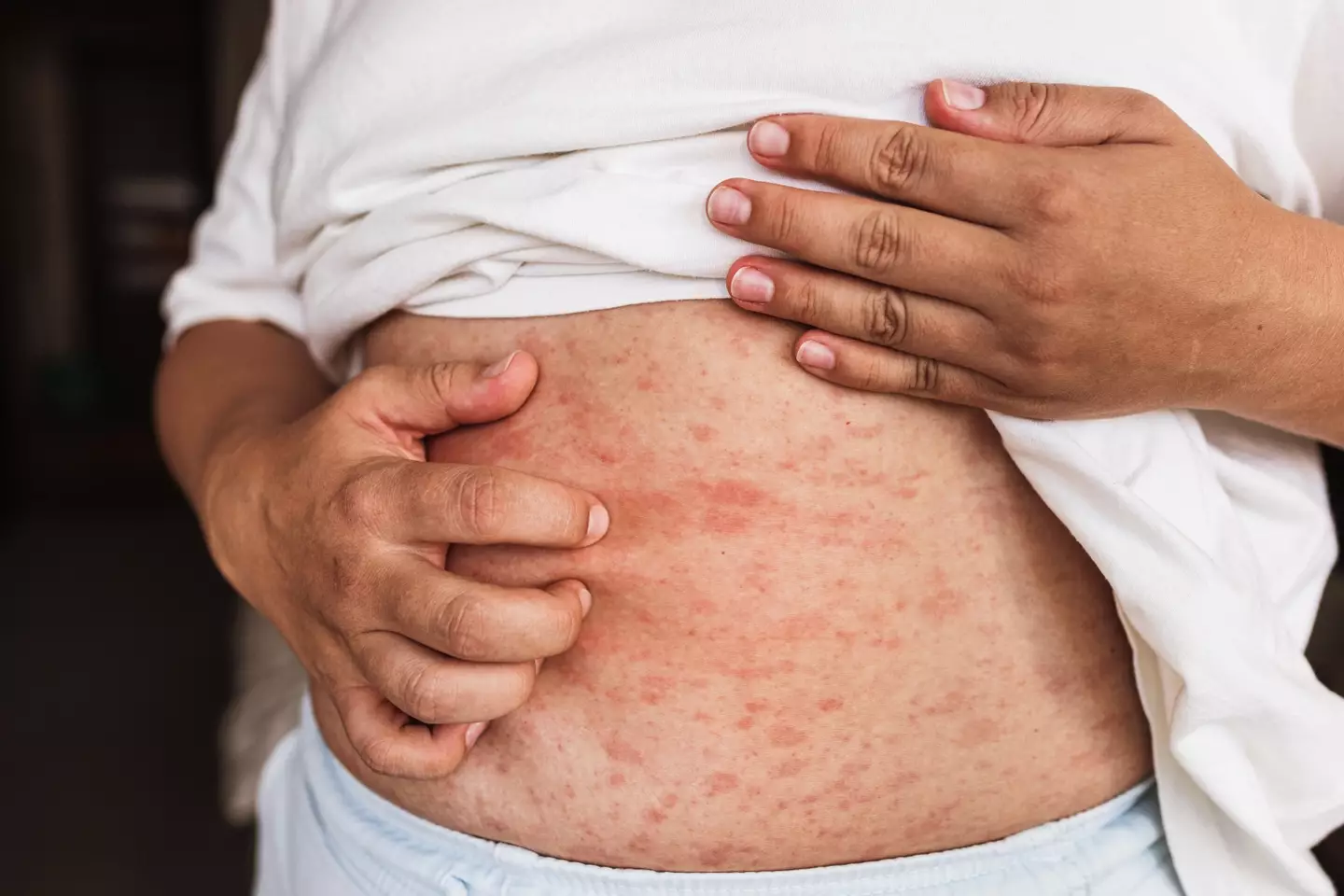 A zinc deficiency caused by a sluggish liver can leave you with dermatitis (Getty Stock)