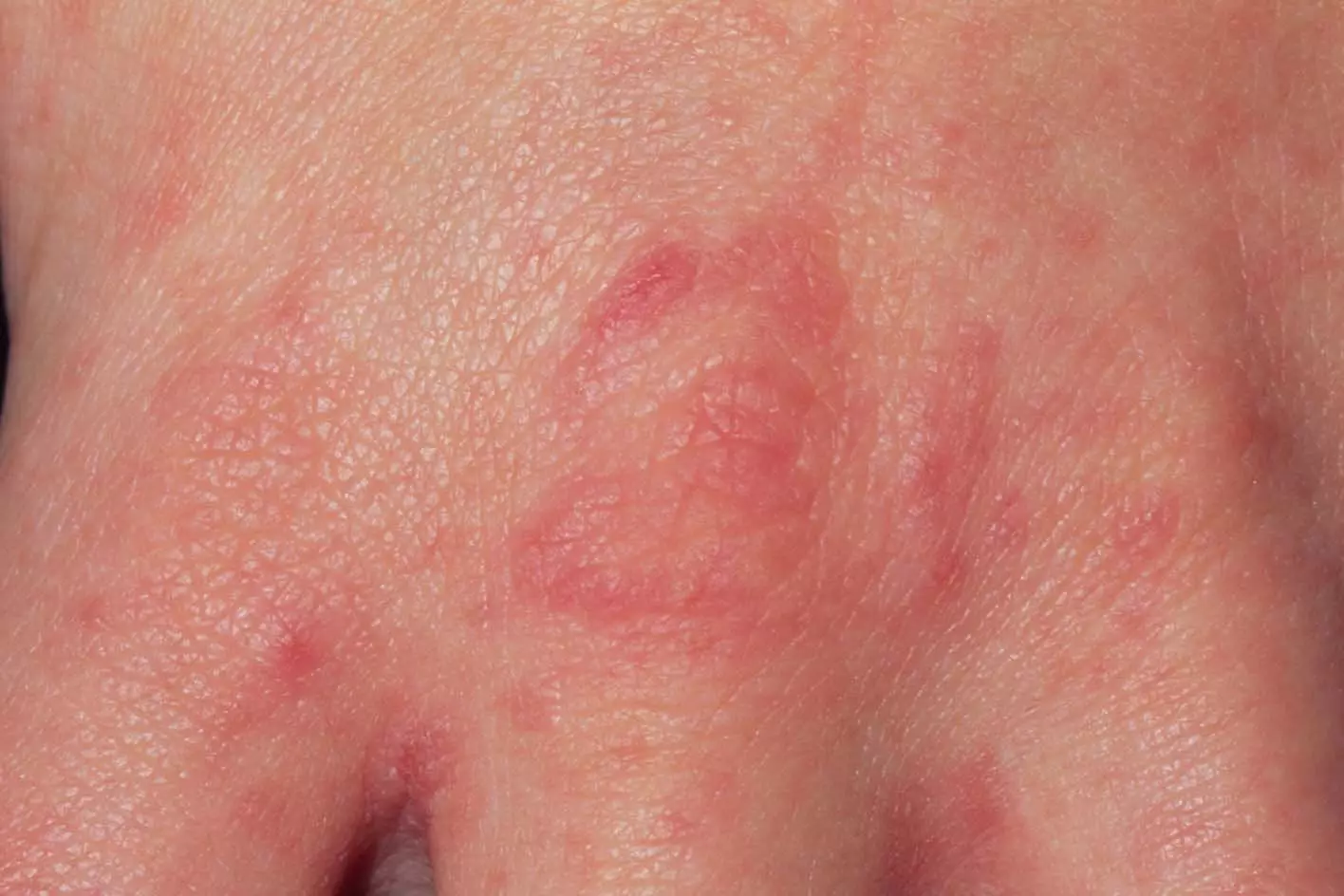 A scabies rash can appear anywhere, but is common between the fingers (NHS)