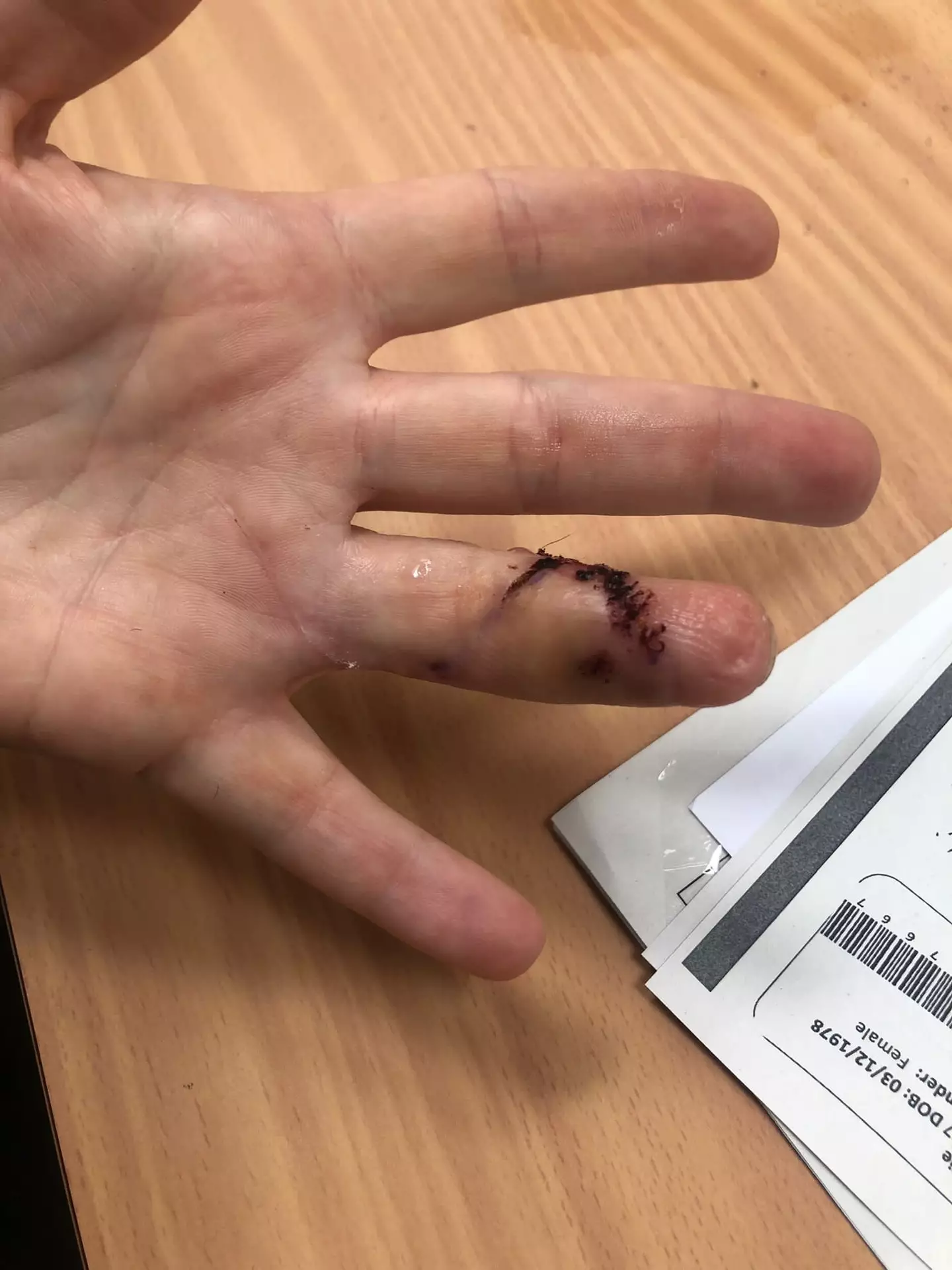 Medics spent six hours reattaching the finger.