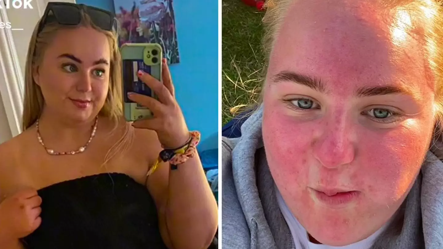 Woman Shares Warning After Suffering Blistering Sunburn From Just One Hour In UK Sun