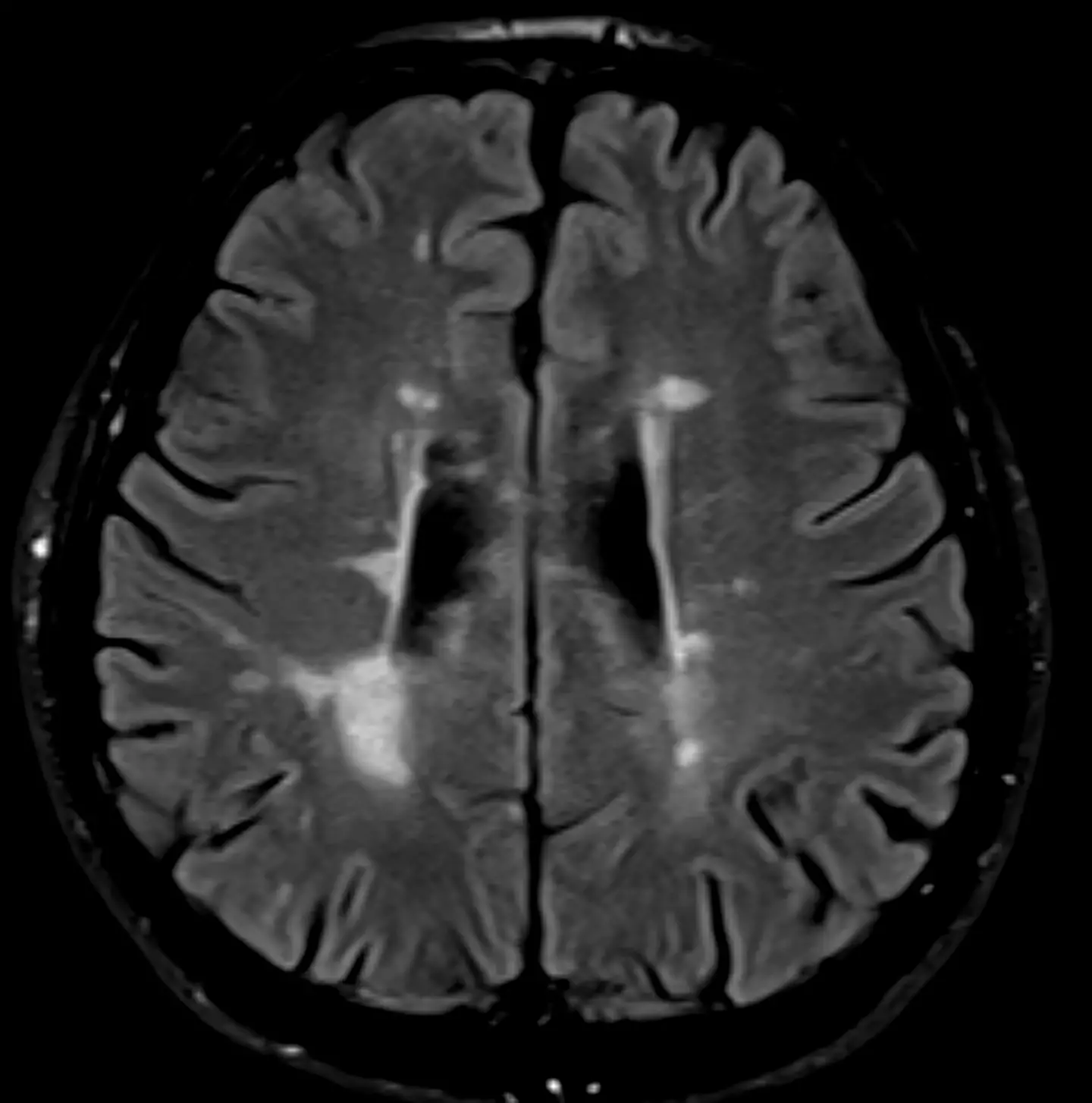 MS affects the brain and the spinal cord.