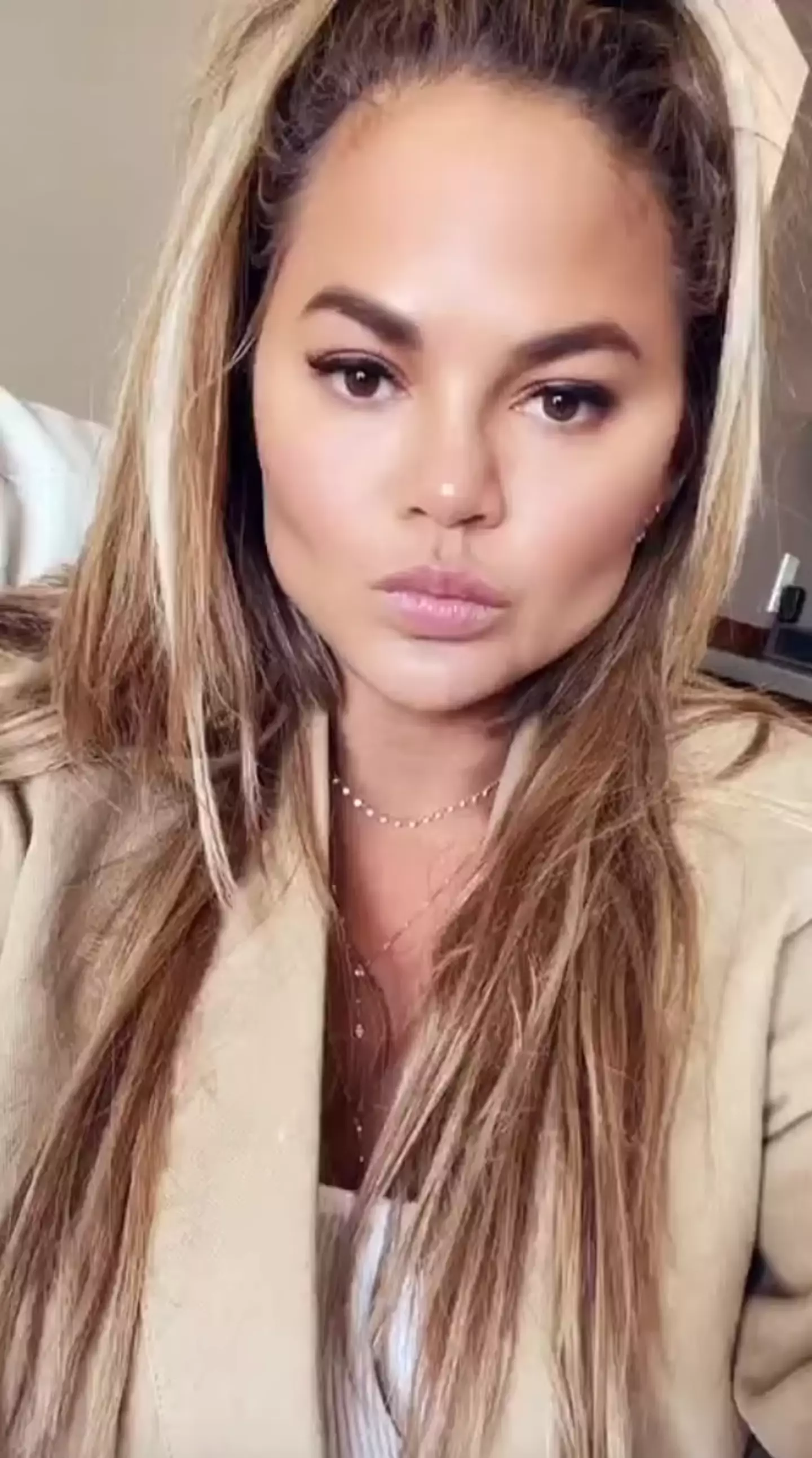 Chrissy Teigen revealed the results of her cheek surgery on Instagram (