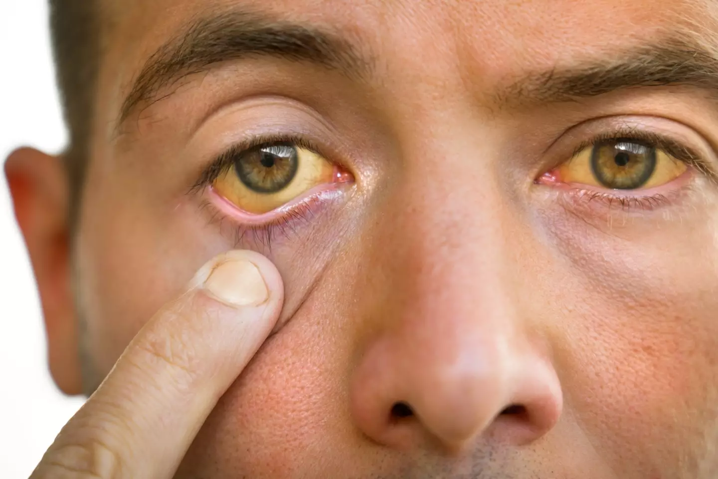 A yellowing of the skin and the eyes could indicate a struggle with jaundice (Daria Kulkova/Getty)