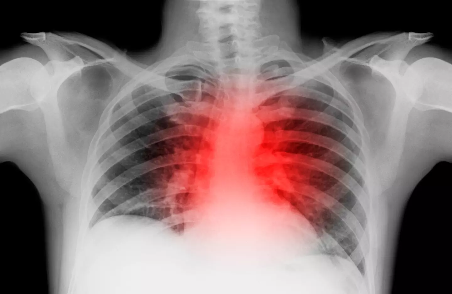 A 'silent heart attack' is just as deadly as a regular one (Getty Stock Image)
