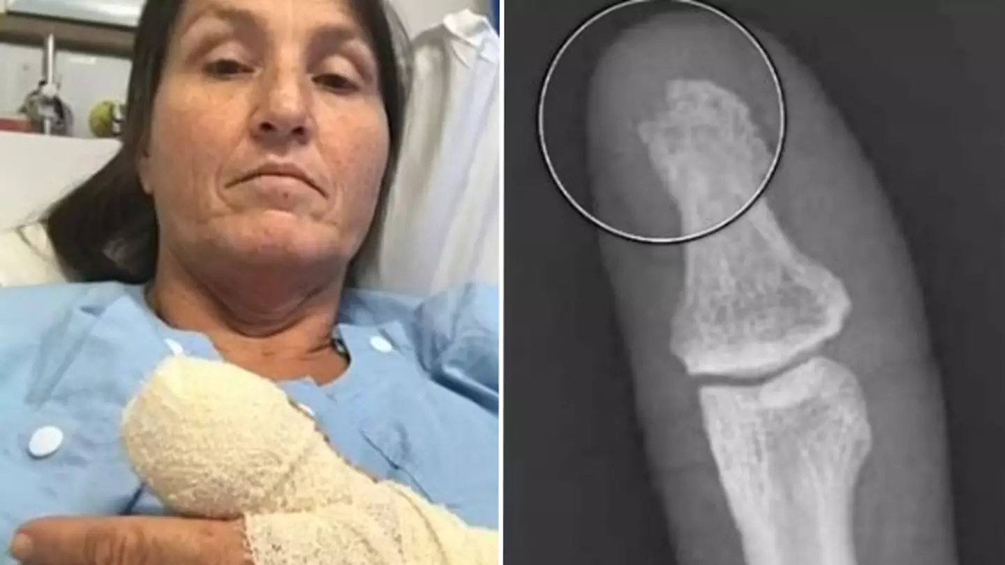 Horror as woman told she could lose a thumb after terrible mistake during manicure