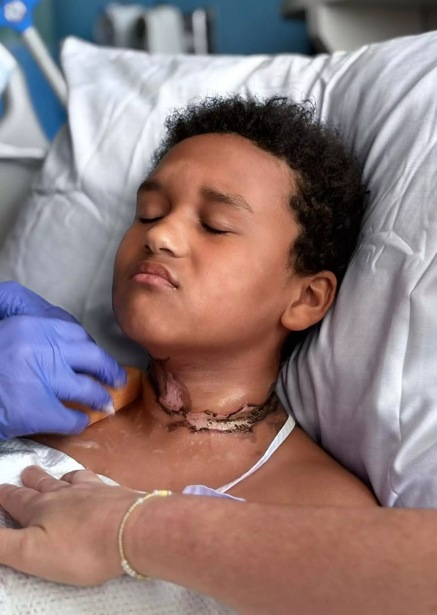 Ashtyn Pitts, nine, suffered horrific burns to his neck and hand (Kennedy News and Media)