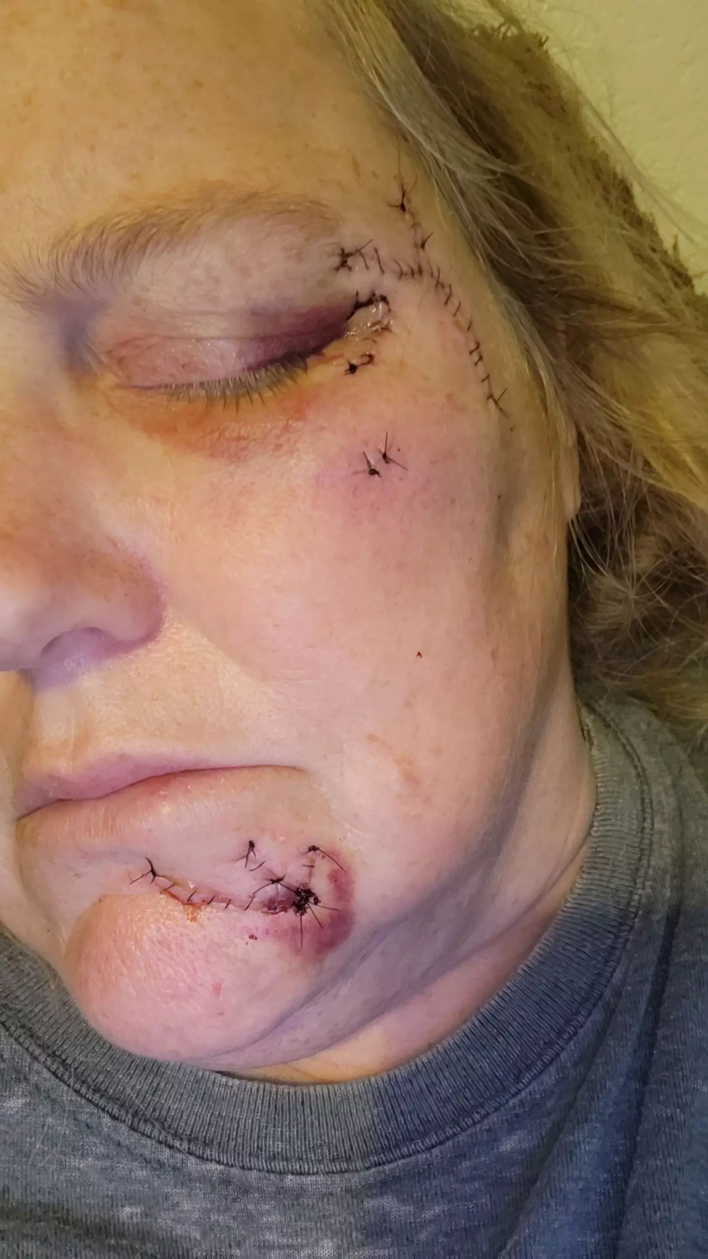 Rhonda the scars she sustained may be permanent.