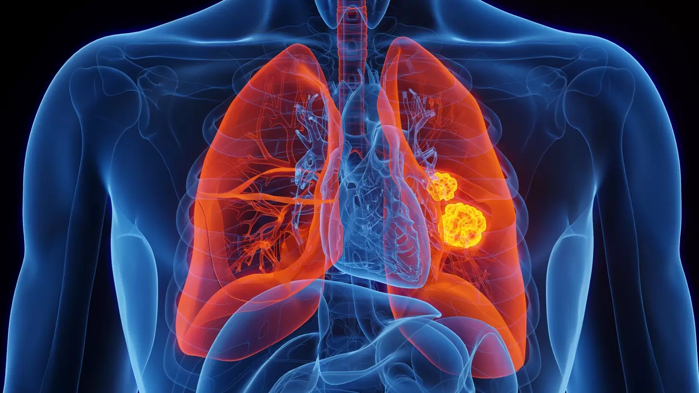 Experts are warning of the less-known symptoms of lung cancer. (Getty stock images)