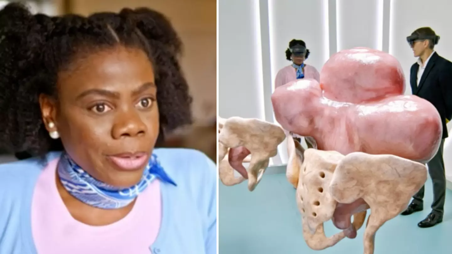Your Body Uncovered Viewers Shocked After Seeing What Fibroids Look Like IRL