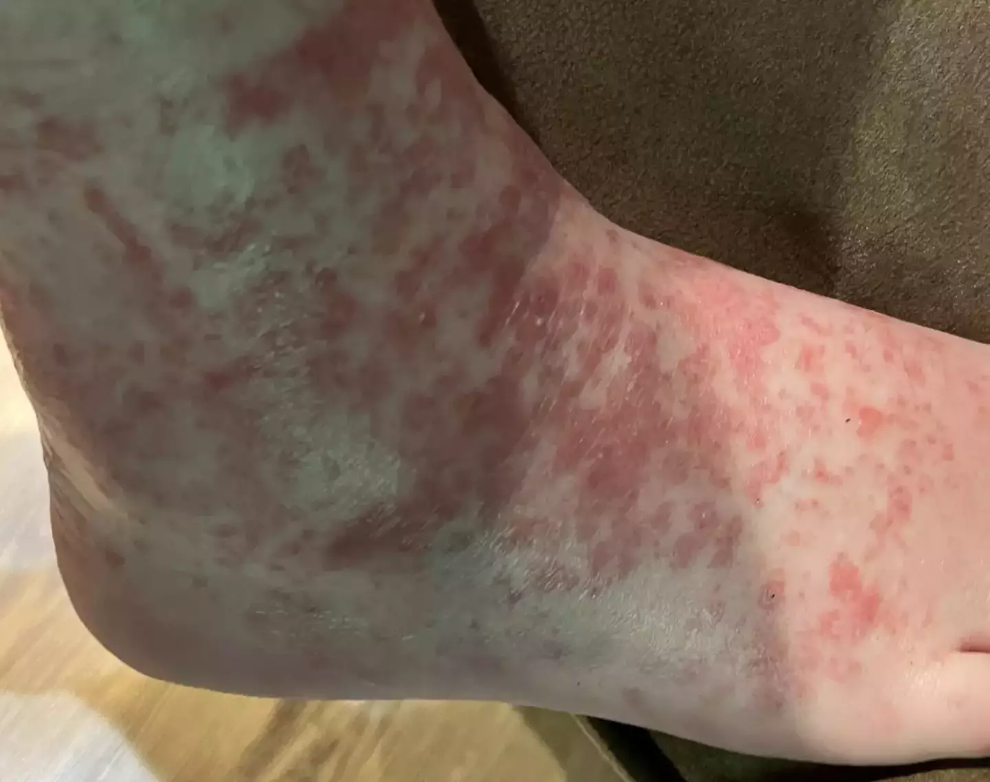 The mum was told the reaction could potentially be scabies.