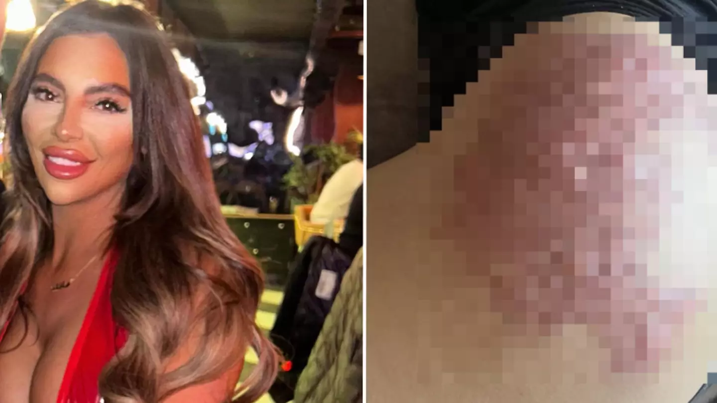 Woman issues warning to others after ‘liquid BBL’ left her with permanent damage