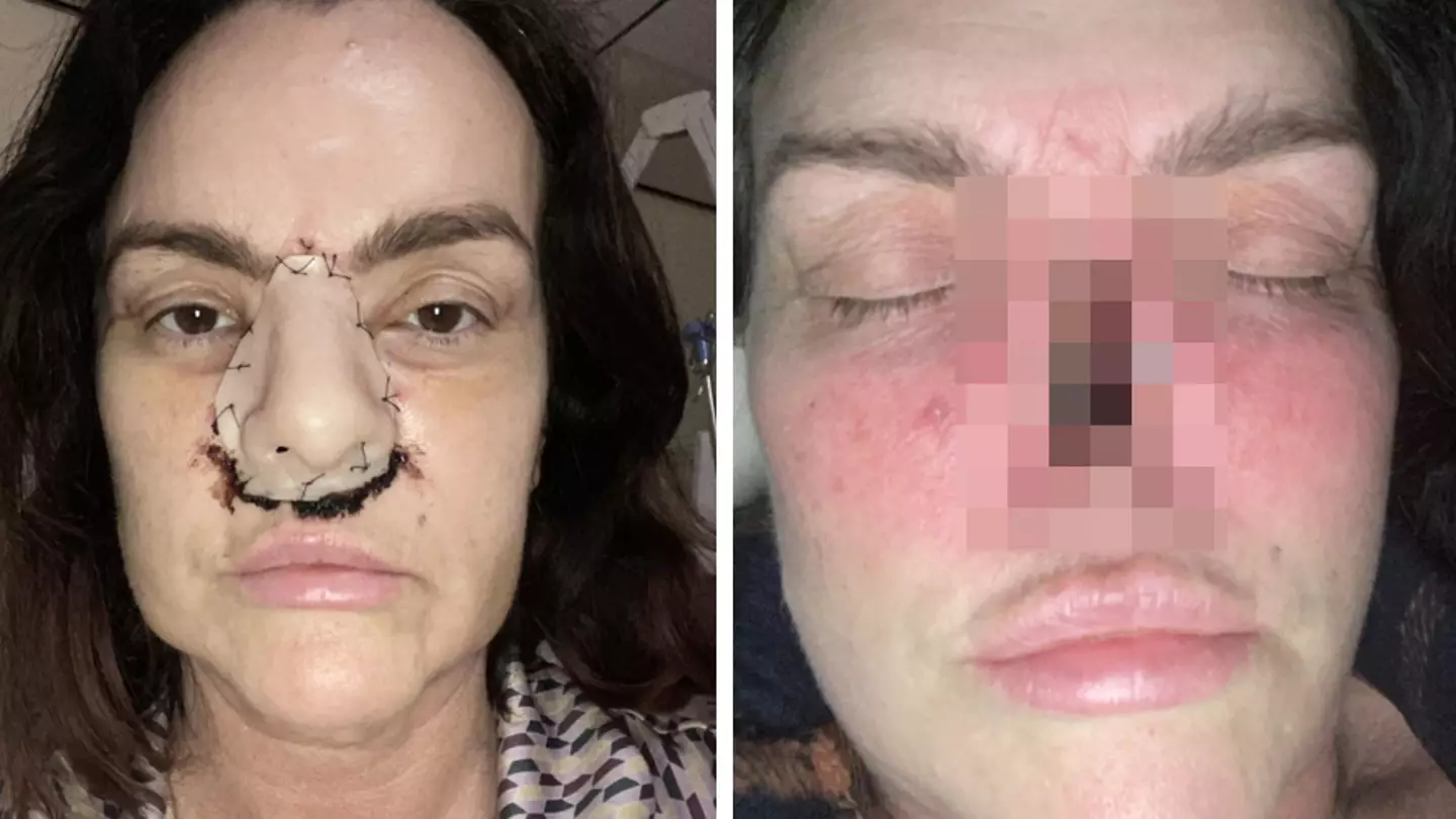 Mum loses her entire nose to cancer after hospital 'cancelled appointment six times'