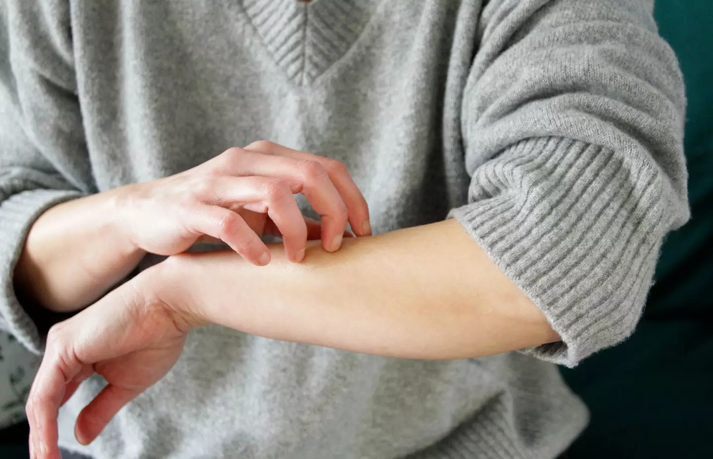 Scabies appears to be on the rise... (Kinga Krzeminska / Getty Images)