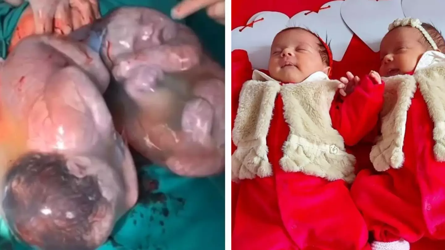 Incredibly Rare Moment Babies Are Born Still Inside Amniotic Sacs