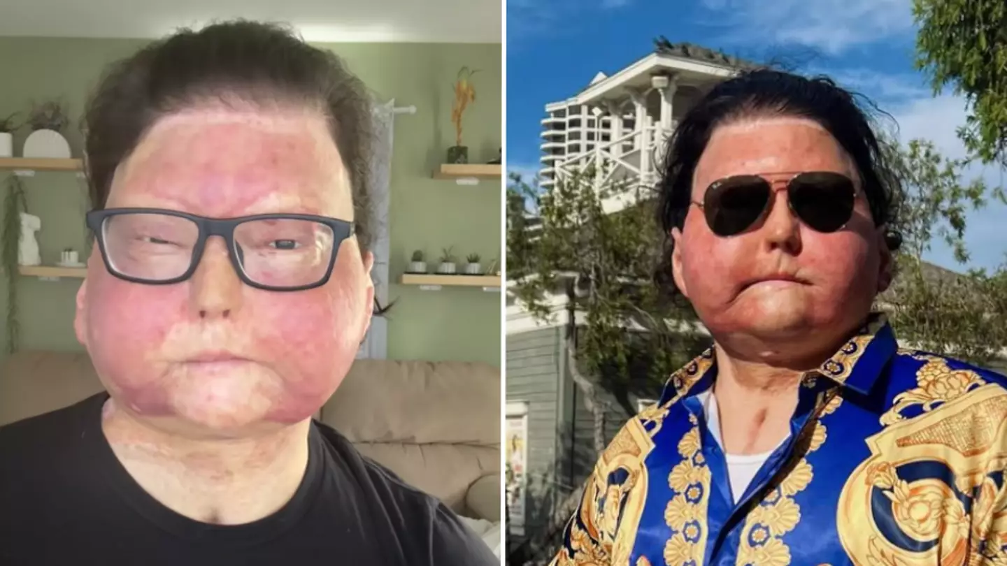 Man who received 47-year-old donor’s face reveals one surprising question he's always asked