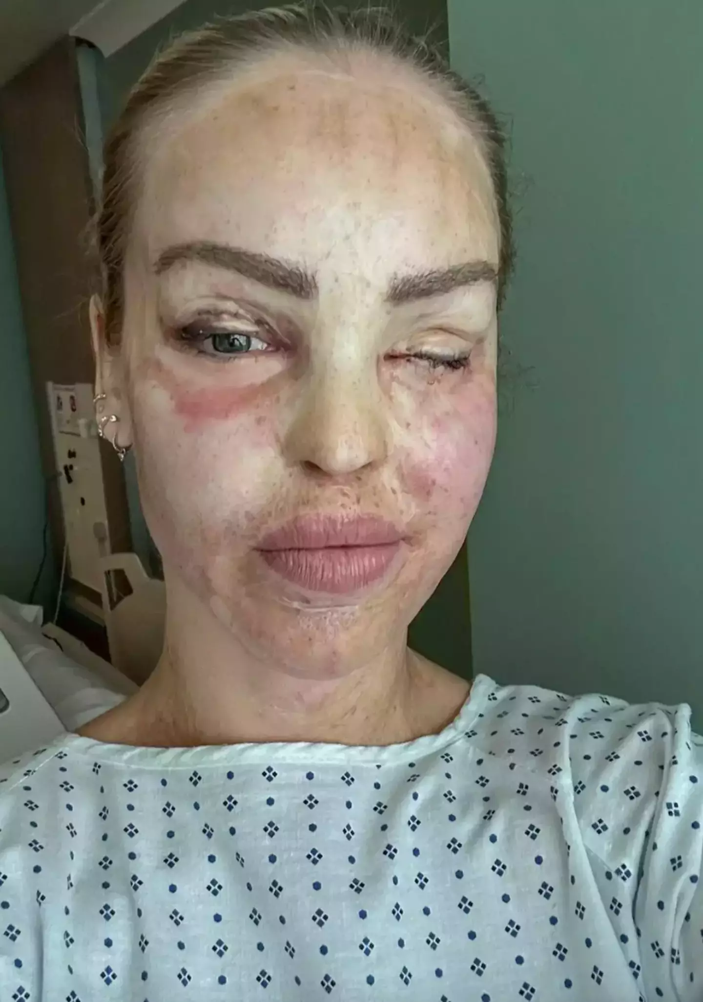 Katie Piper has had her eye sewn shut to help 'preserve' her eye.