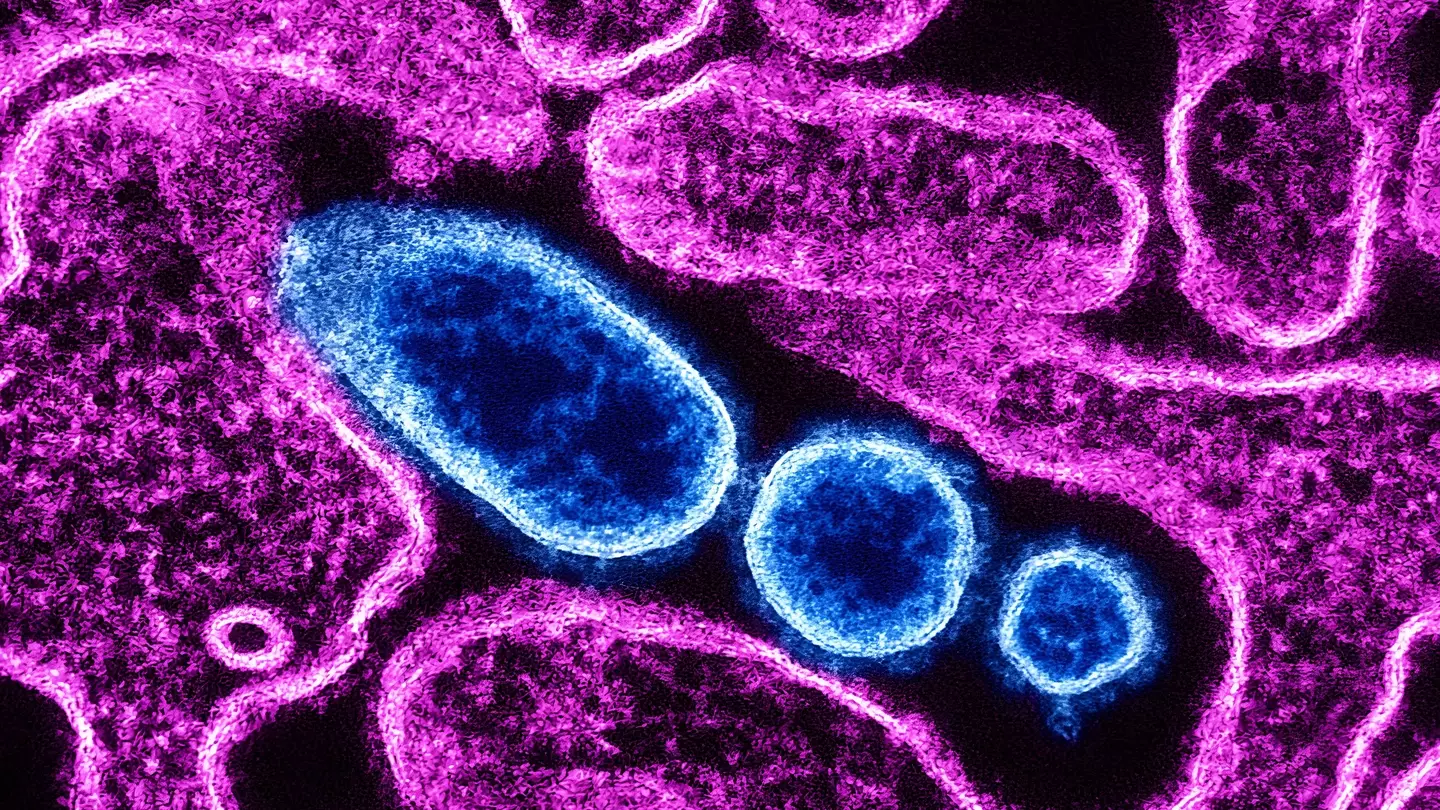 NIH-NIAID/Image Point FR/BSIP/Universal Images Group via Getty Images