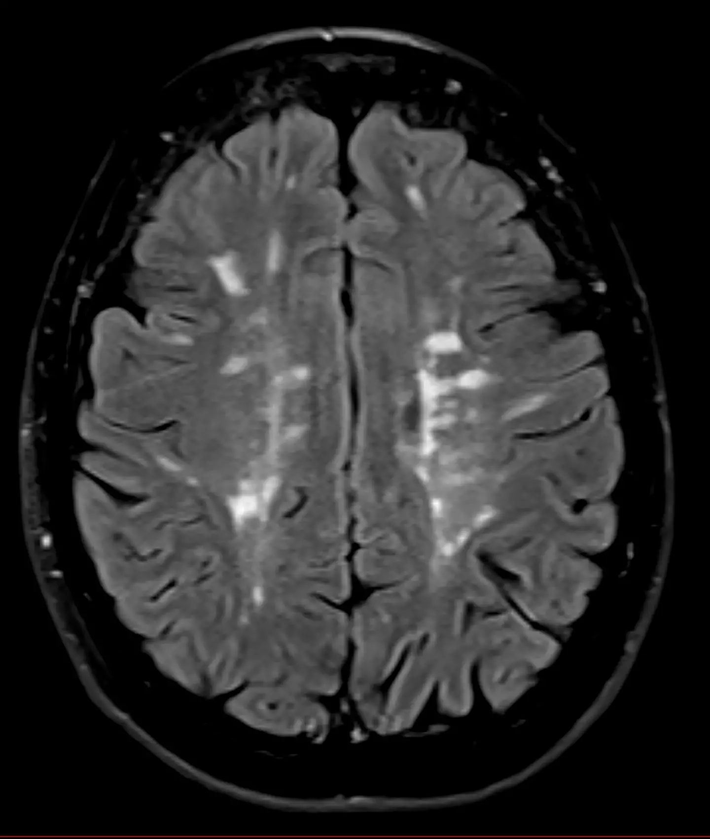 MS is a chronic, often disabling autoimmune disease (Getty Stock Image)