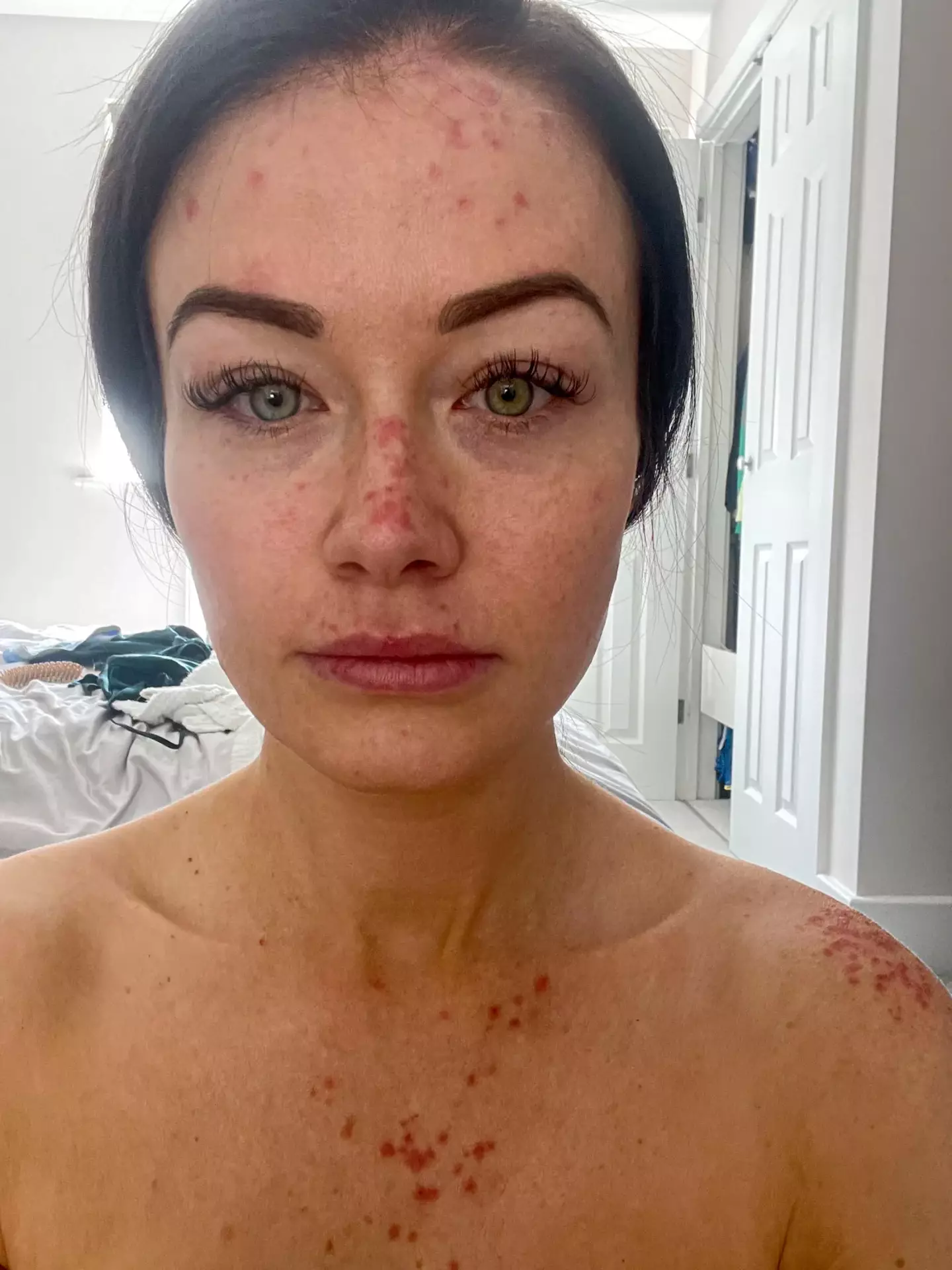 Jess Impiazzi thought was dying after getting severe flare ups of autoimmune disease symptoms.