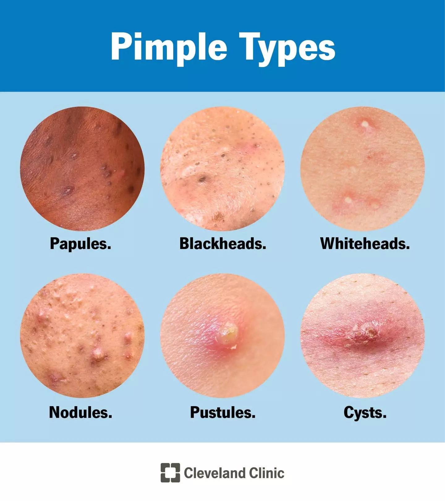 Acne can come in many different forms (Cleveland Clinic)