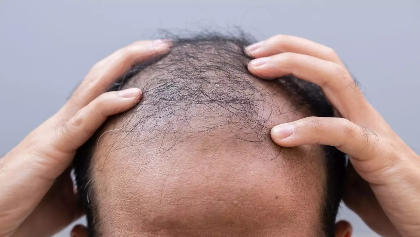 Your relatives and your family photo albums could hold the answer to whether or not you will go bald in the future (Getty Stock Image)