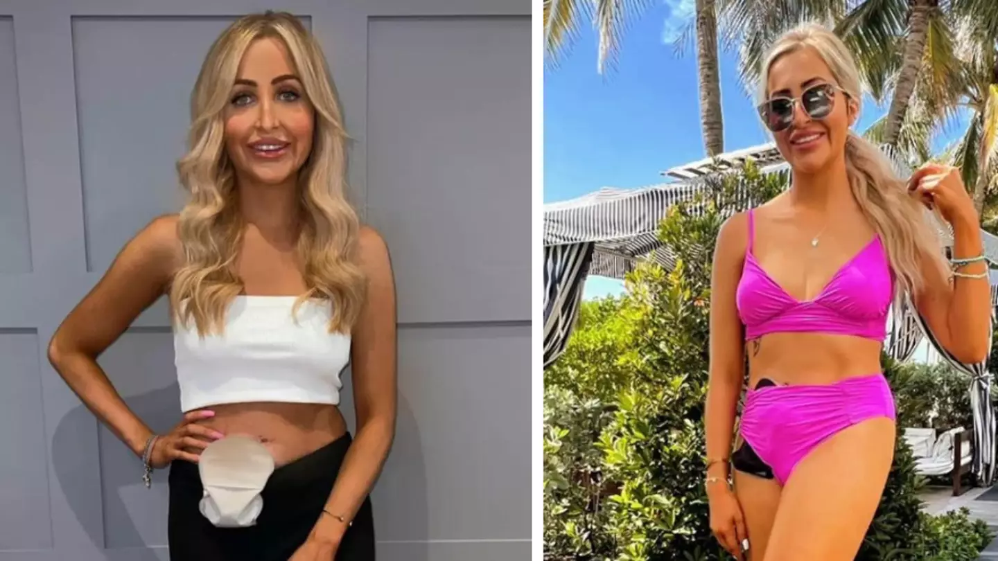 Woman whose colon and rectum have been removed feels more confident with stoma bag