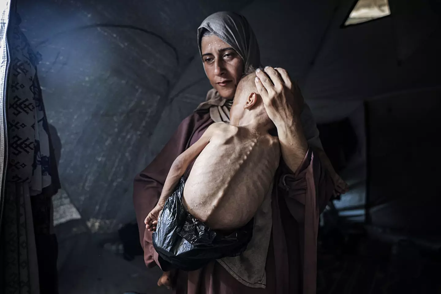 Muhammad Zakariya Ayyoub al-Matouq, a 1.5-year-old child in Gaza City, faces life-threatening malnutrition as the humanitarian situation worsens due to ongoing Israeli attacks and blockade (Anadolu / Contributor / Getty Images)
