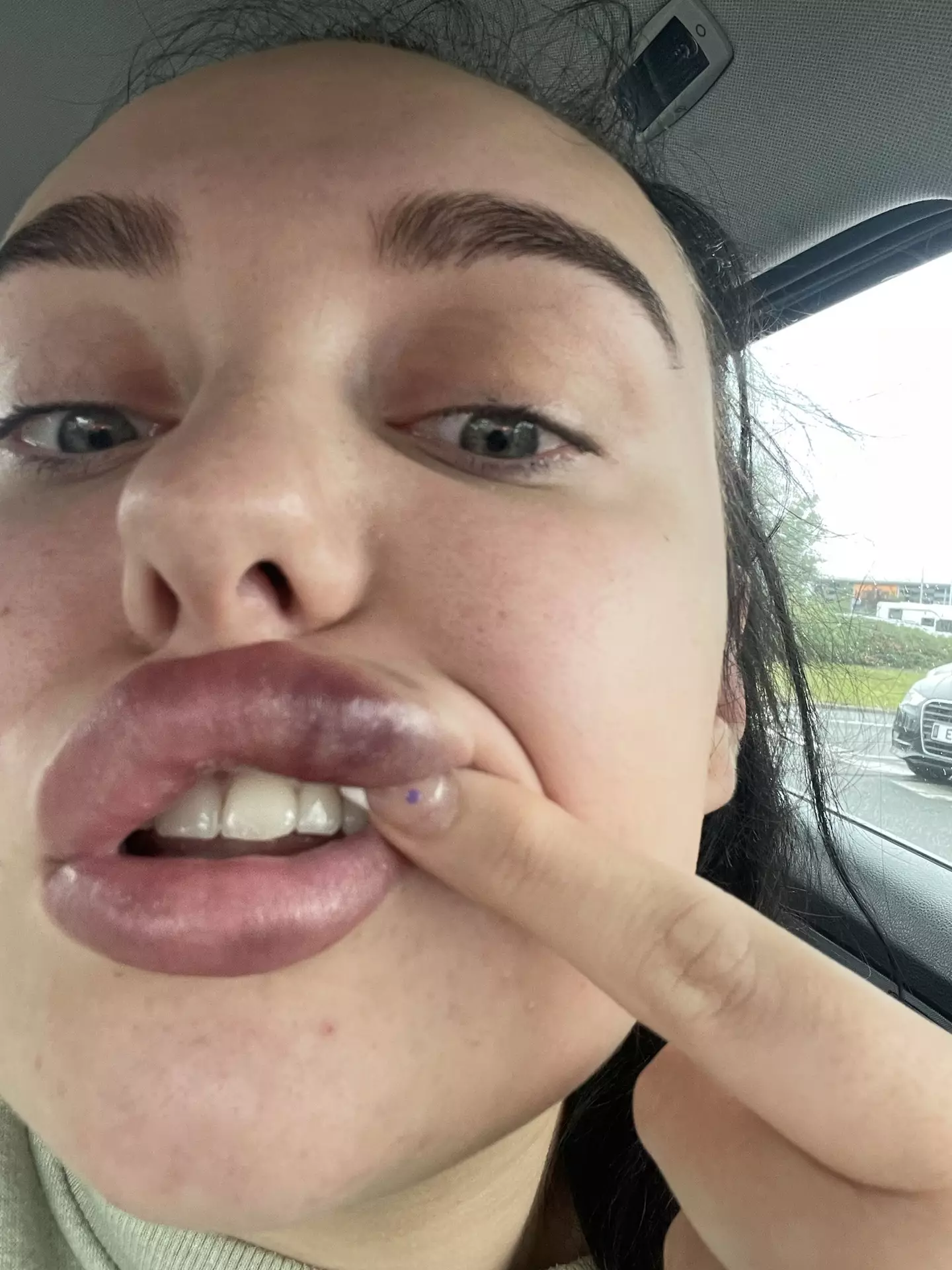 Doctors said Amy was lucky to still have her lip (