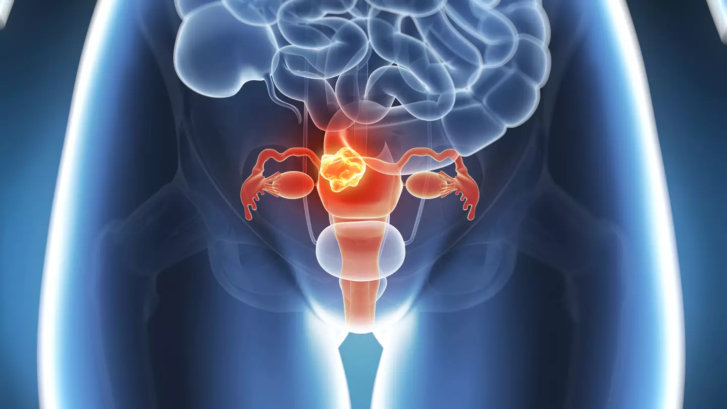 Woman had no idea one 'annoying' symptom was actually vulval cancer
