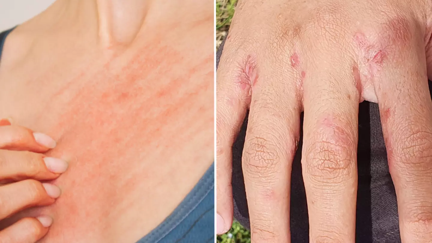 Brits issued warning over rise in highly contagious skin disease across UK