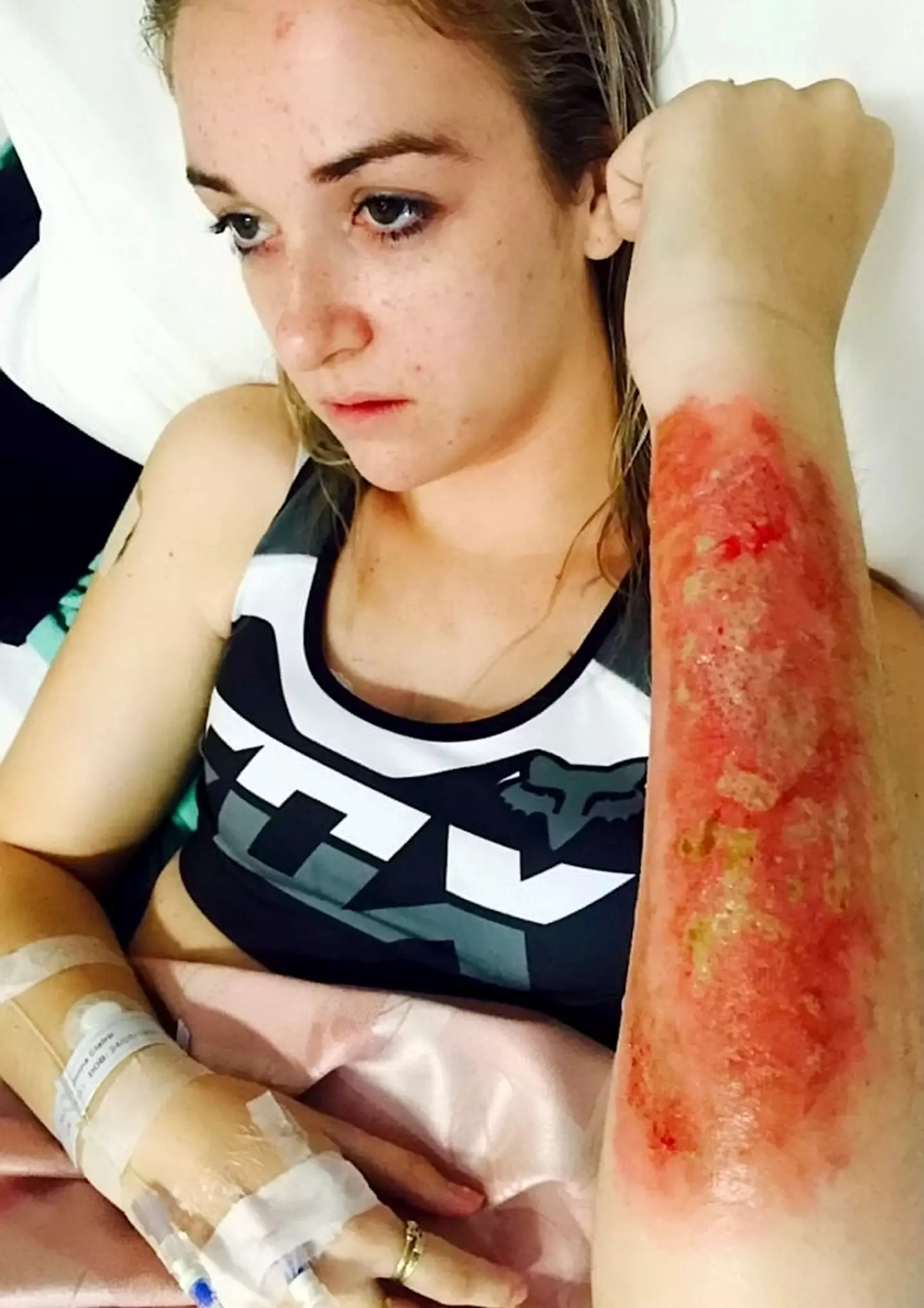 The mum-of-two had a skin graft on her wound but it only worked for a year.