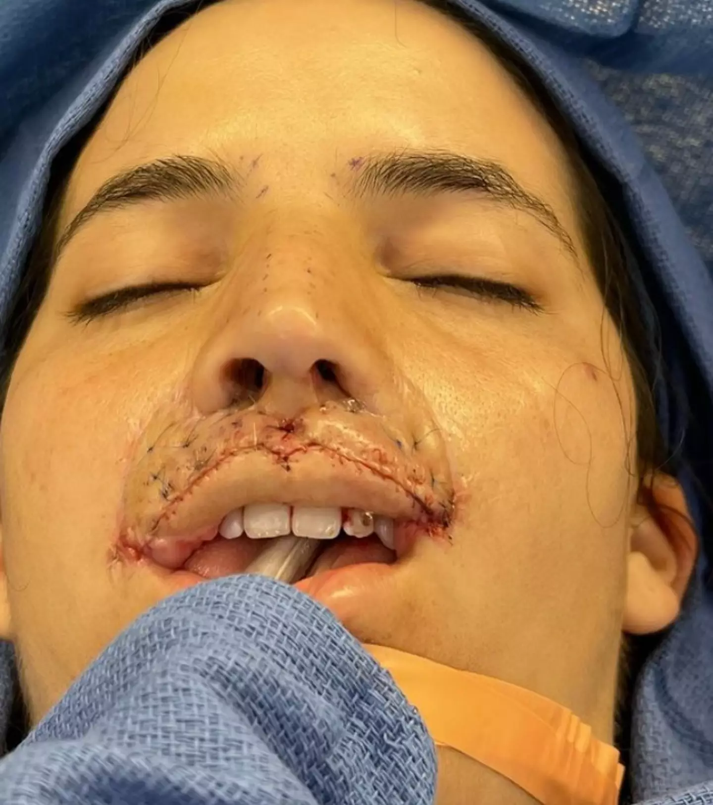 Brooklinn explained that her surgeon had 'recreated the central columns, the lip and the cupids bow'.