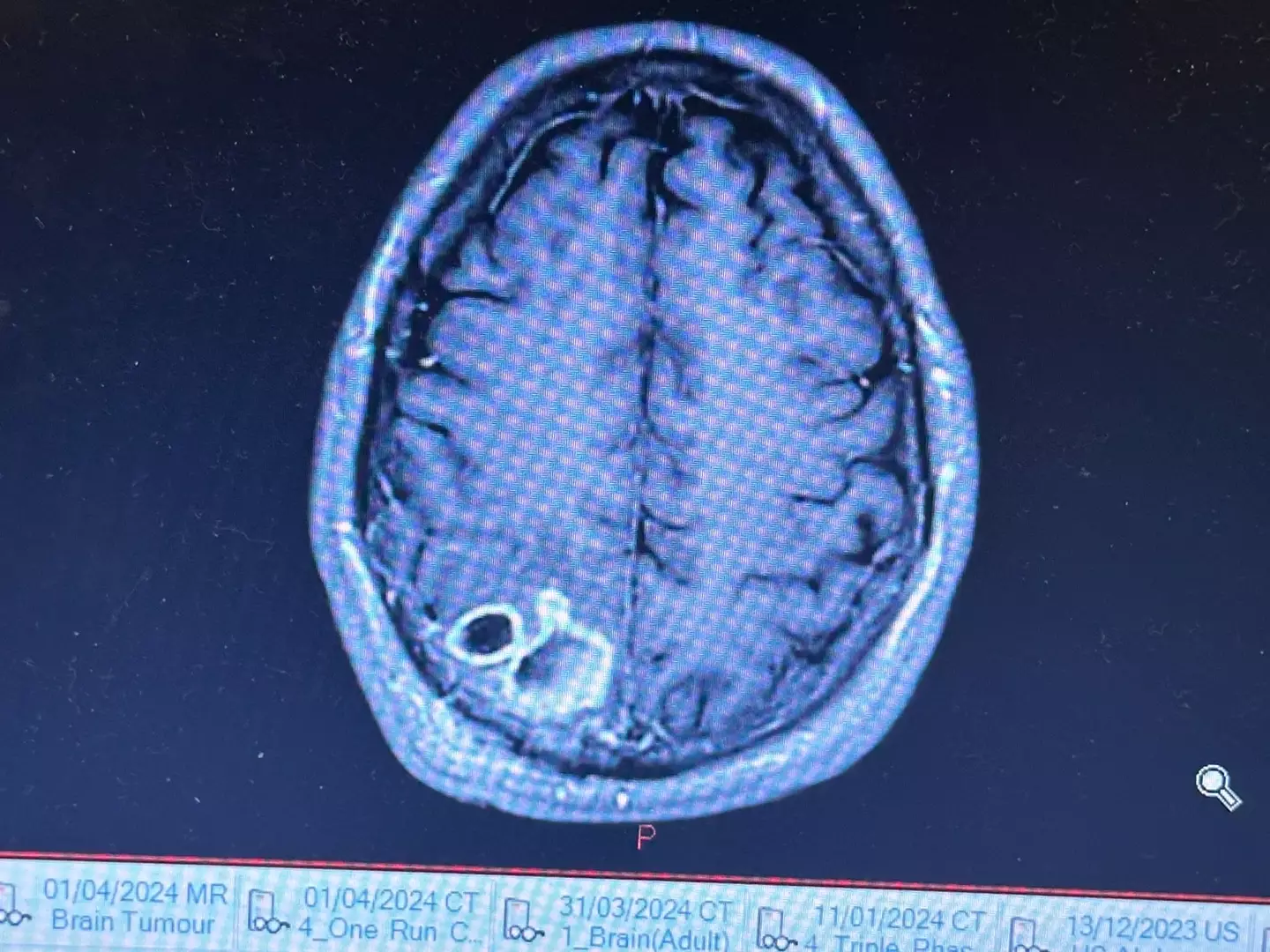 Doctors found a mass on Callum's brain. (Reach PLC)