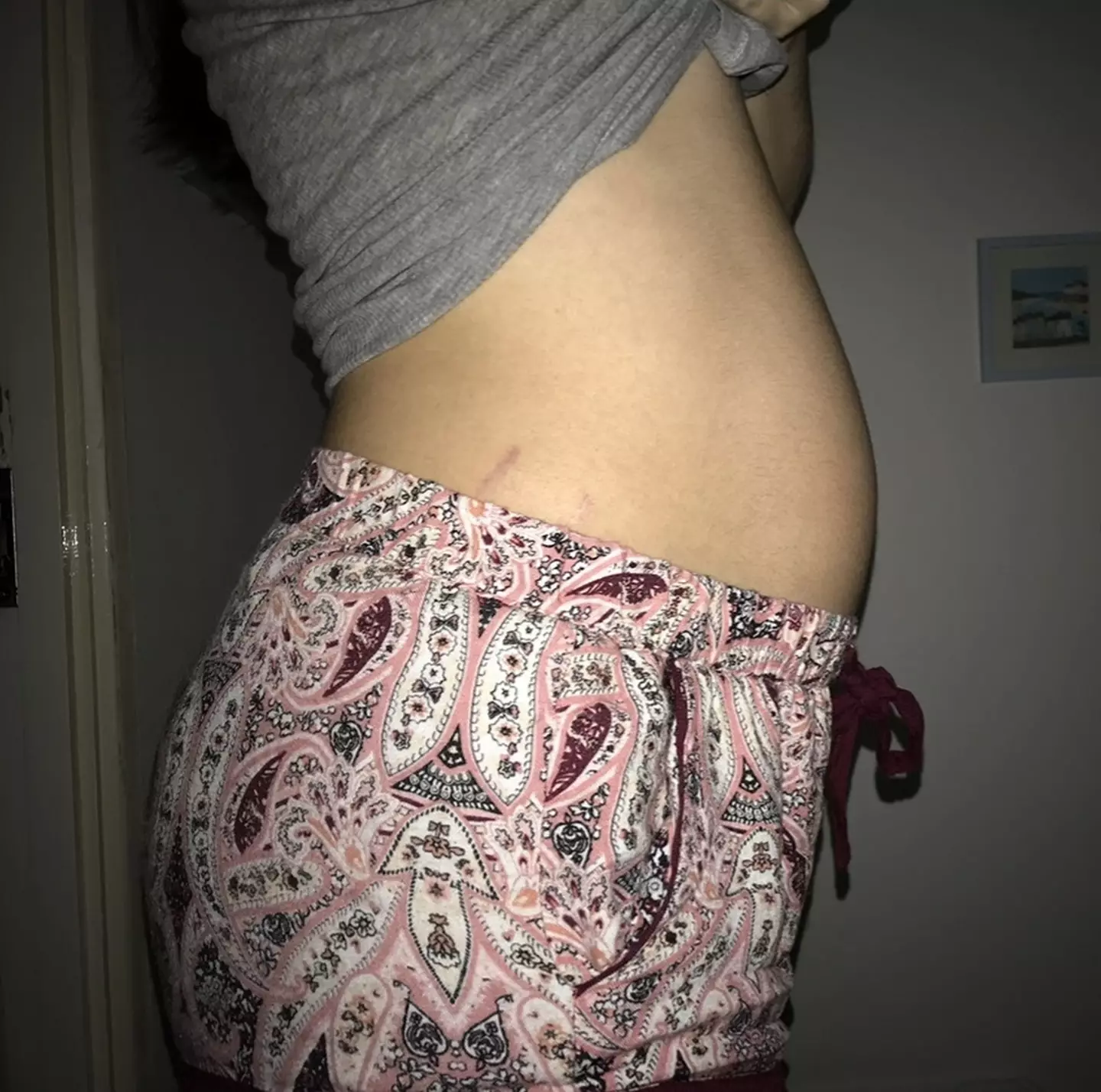 Ellie had abdominal pains but otherwise no pregnancy symptoms (