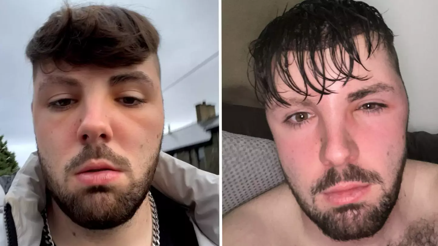 Man who had hair transplant ignored doctor's ‘no sex’ warning and faced serious consequences