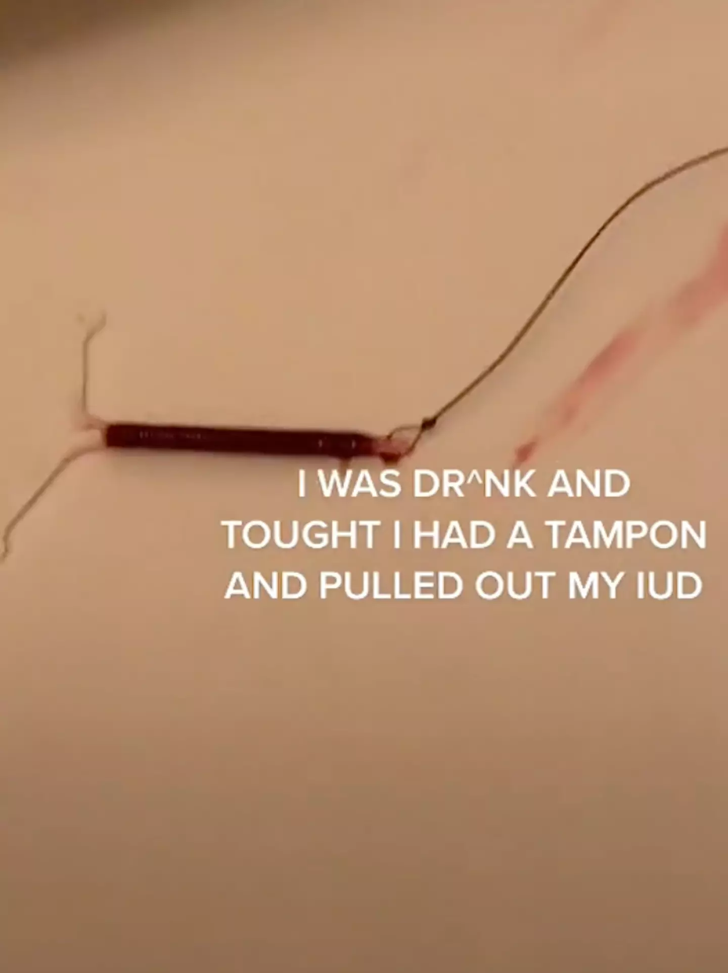 Natalia explained she accidentally removed her IUD (