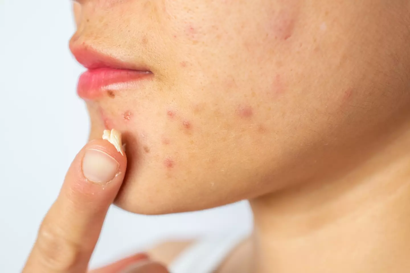 Chin and jawline spots can have several triggers (Boy_Anupong/Getty)