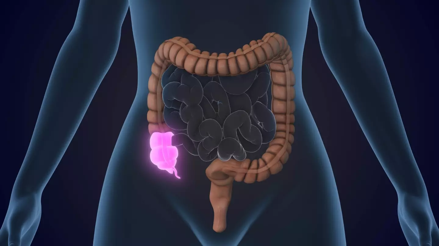 Appendix cancer symptoms to look out for as 'tip of the iceberg' warning is issued to millennials