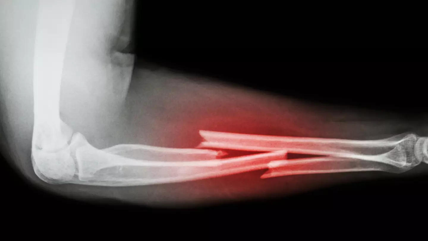 Doctor reveals what it means if you've never broken a bone as eerie conspiracy theory goes viral